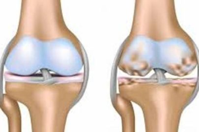 knee osteoarthritis treatment in indore