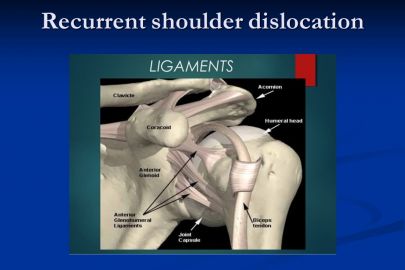 recurrent shoulder dislocation surgery