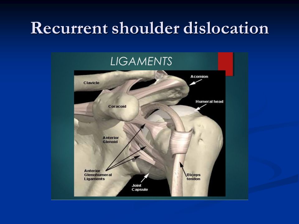recurrent shoulder dislocation surgery